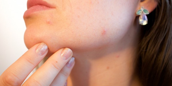 Huiles essentielles : Découvrez le remède miracle naturel contre l’acné, les boutons et les démangeaisons